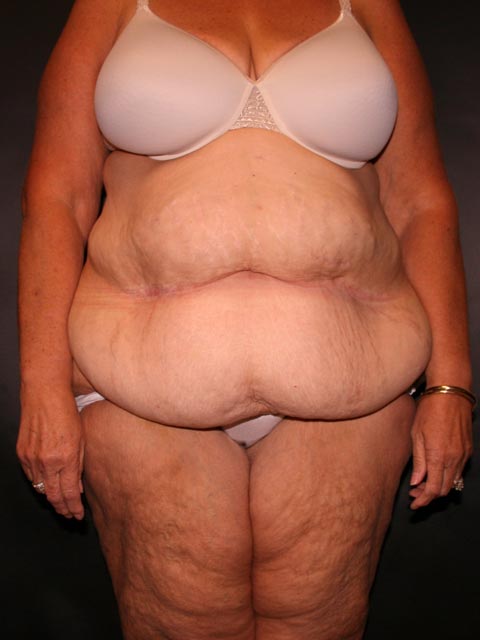 Panniculectomy Pre-Surgery