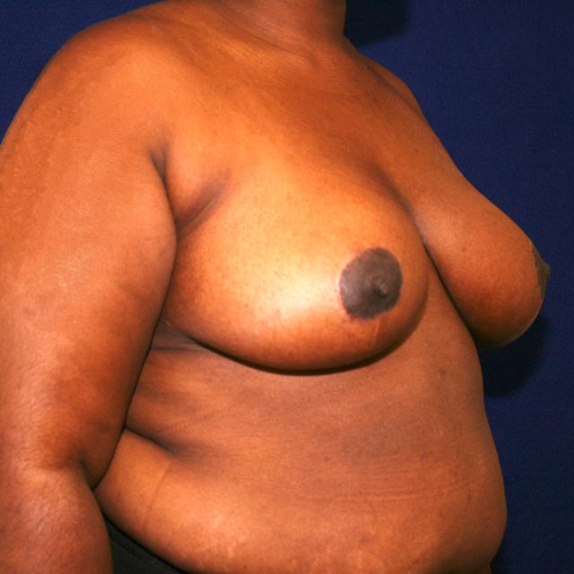 breast reduction pre-surgery